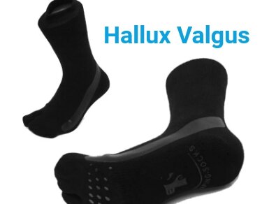 Hallux Valgus